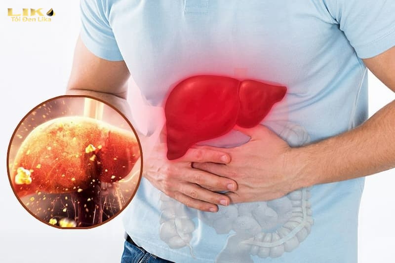 Ăn tỏi đen có tốt cho gan không? Cách ăn tỏi đen hiệu quả cho người bị bệnh gan 2 ăn tỏi đen có tốt cho gan không